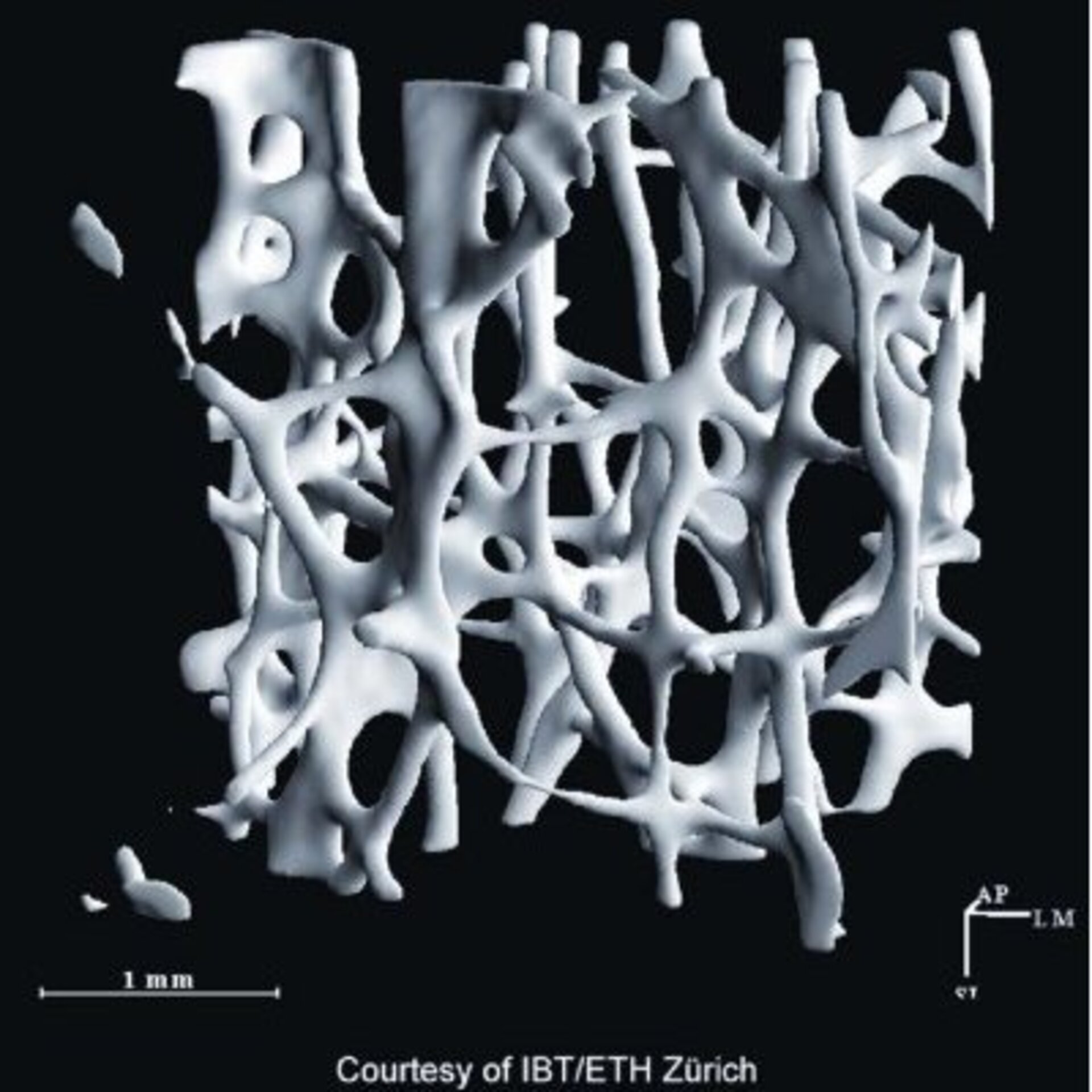 Bone structure affected by bone loss